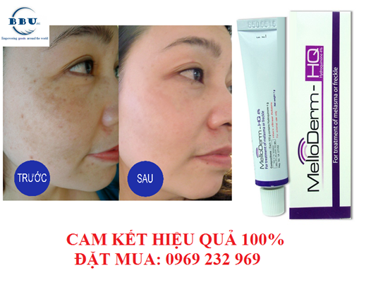 Giai-phap-tri-nam-nhanh-nhat-voi-Melloderm-4